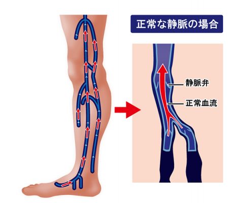 正常な静脈の場合