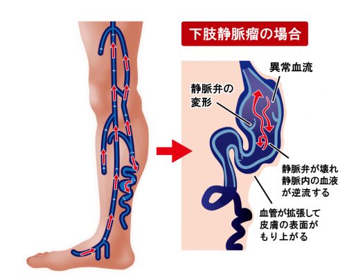 神戸静脈瘤クリニック 下肢静脈瘤治療の外科クリニック