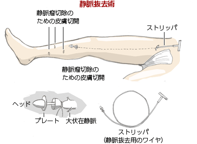 下肢静脈瘤ストリッピング手術(保険診療)